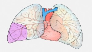 Pulmonary Embolism