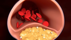 Arteries clogged If you’re Overweight it’s Harder to Tell