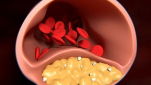 Arteries clogged If you’re Overweight it’s Harder to Tell