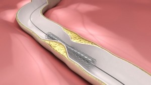 heart health stents