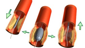 stents2