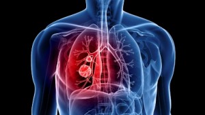 LUNG DISEASE